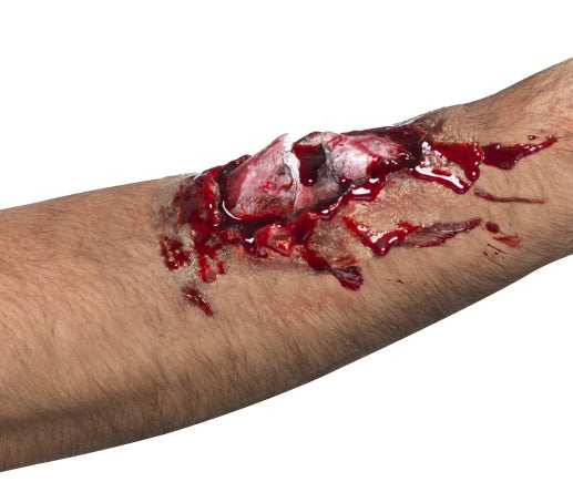 Gebrochener Knochen - 1